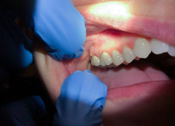 Best Chipped Tooth Repair Near Me  in Davie, FL